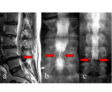 腰部脊柱管狭窄症例