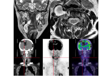ダンベル型脊髄神経鞘腫のGd造影後MRIおよびFDG-PET所見