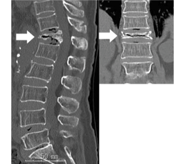 脊椎圧迫骨折の胸腰椎CT