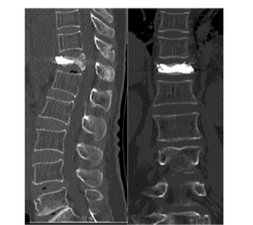 脊椎圧迫骨折BKP療法後のCT