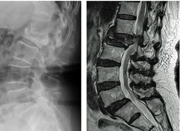 脊椎圧迫骨折後の遅延性馬尾神経障害