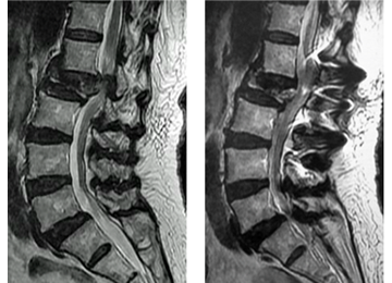 脊椎圧迫骨折治療前後の腰椎MRI