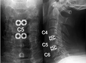 チタン製ケージによる頸椎前方除圧固定術後の頸椎CT