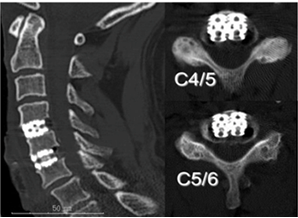 チタン製ケージによる頸椎前方除圧固定術後の頸椎CT