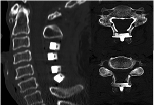 頸椎椎弓形成術後の頸椎CT