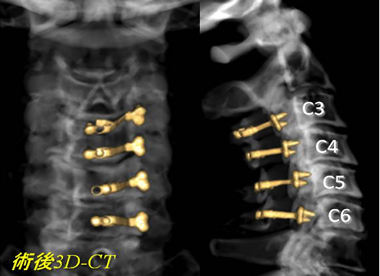 片開き式の頸椎椎弓形成術後の頸椎3D-CT