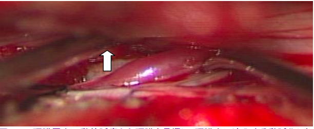 動静脈瘻から硬膜内に流入する動脈化したdraining vein