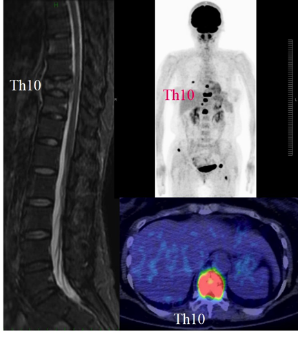 転移性脊椎腫瘍による脊椎圧迫骨折の術前MRI