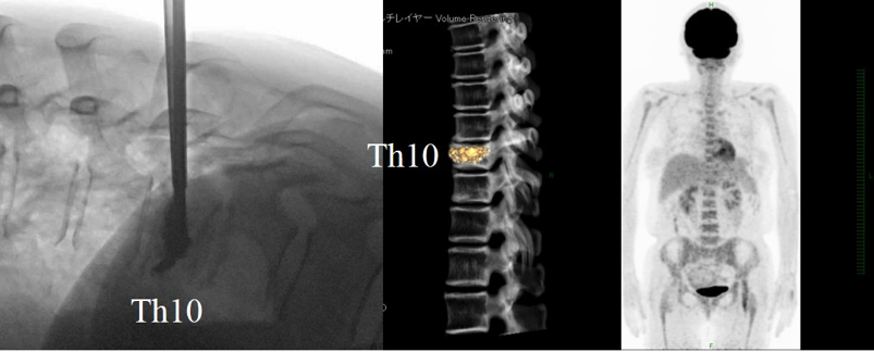 転移性脊椎腫瘍による脊椎圧迫骨折の治療前後画像