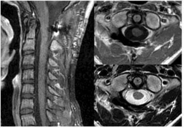 脊髄硬膜内髄外腫瘍の術後2年の頸椎MRI