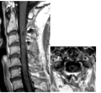 脊髄髄内腫瘍術後2年のGd-MRI