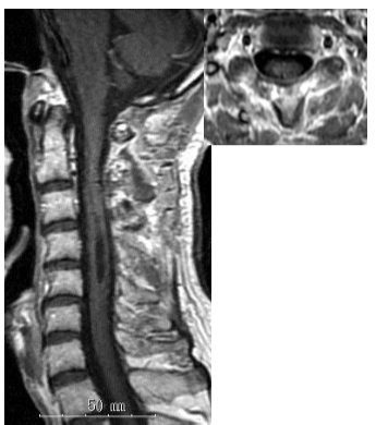 脊髄髄内腫瘍の術後Gd造影後MRI