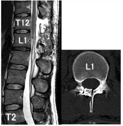 脊髄髄内腫瘍の術後MRI