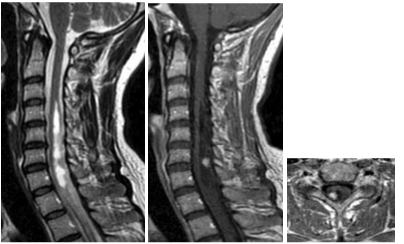 脊髄髄内腫瘍の術前MRI