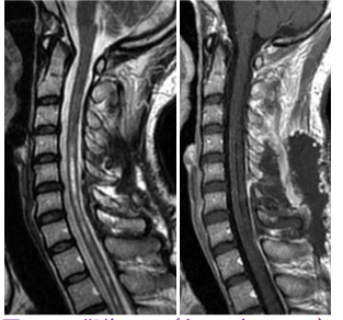脊髄髄内腫瘍の術後MRI