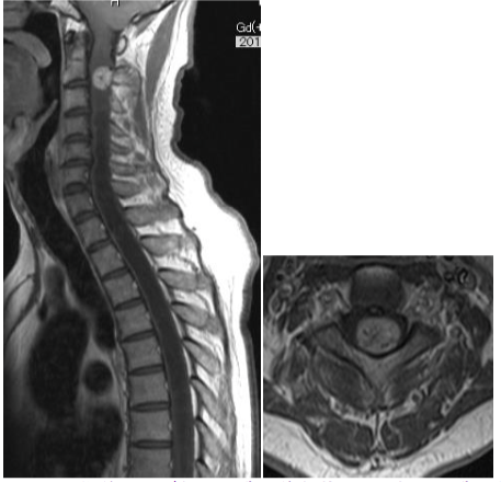 脊髄髄内腫瘍の術前MRI
