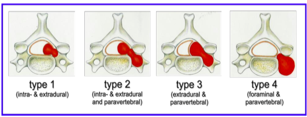 ダンベル型脊髄神経鞘腫の分類