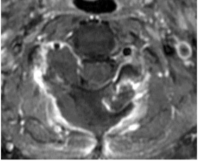 ダンベル型脊髄神経鞘腫の腫瘍摘出後MRI