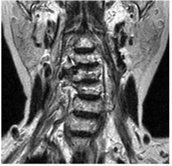 ダンベル型脊髄神経鞘腫の腫瘍摘出後MRI