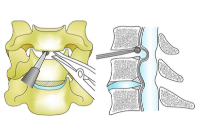 頸椎症性脊髄症の模式図
