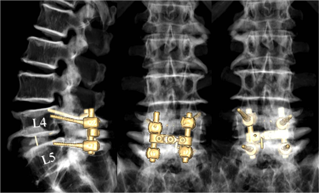 腰椎変性すべり症例に対するCBT固定の術後3D-CT
