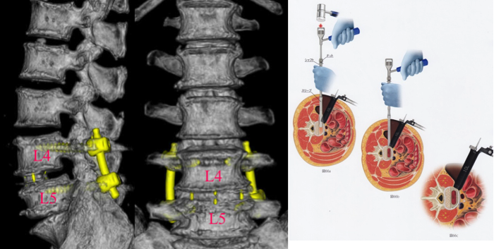 OLIF術後3D-CT