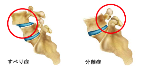 腰椎分離症の模式図