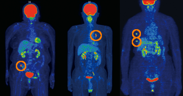 PET-CT症例