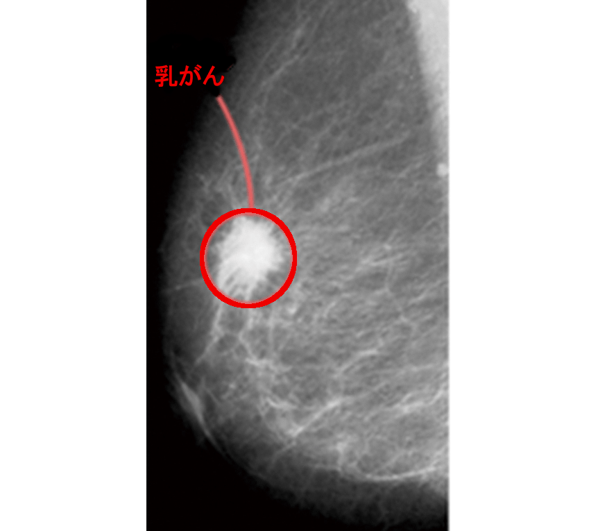 マンモグラフィ症例