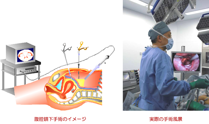 婦人科の腹腔鏡下手術