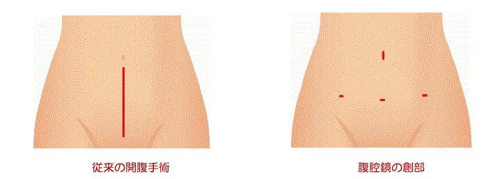 腹腔鏡下手術の創部