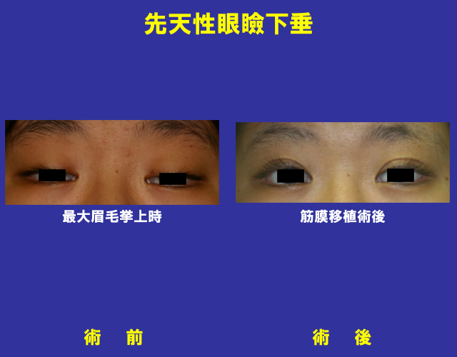 先天性眼瞼下垂の術前術後