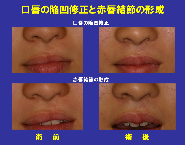 口唇の陥没修正と赤唇結節の形成