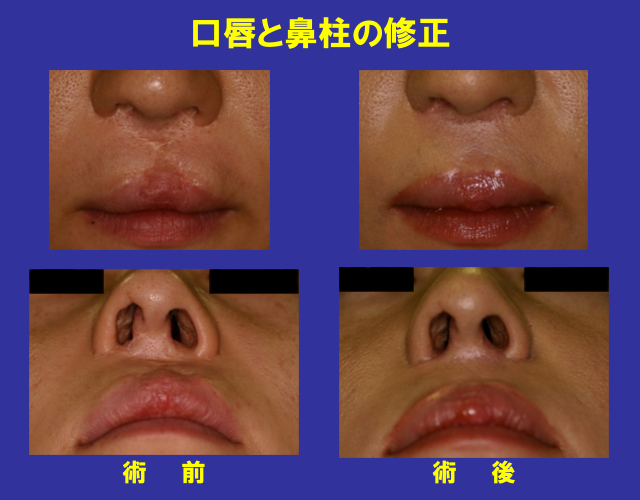 口唇と鼻柱の修正