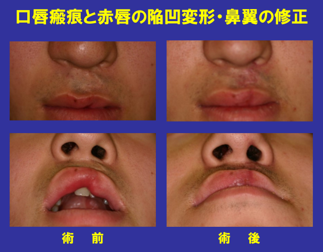 口唇瘢痕と赤唇の陥凹変形・鼻翼の修正