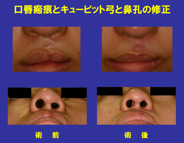 口唇瘢痕とキューピット弓と鼻孔の形成