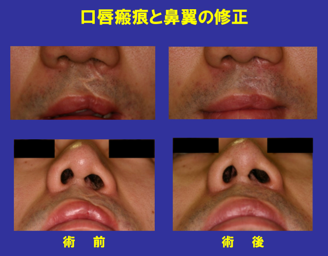 口唇瘢痕と鼻翼の修正