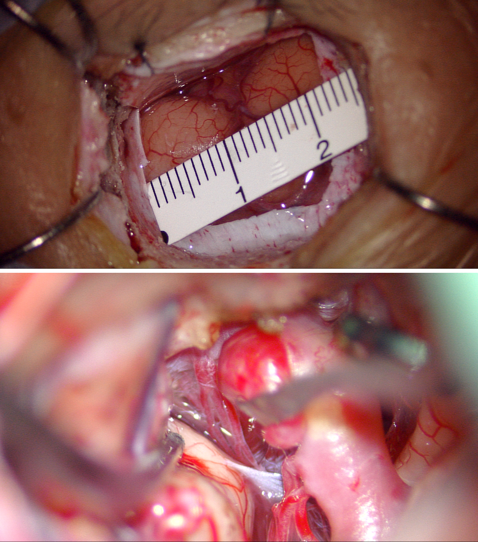 脳動脈瘤に対する鍵穴手術・クリッピング術の様子