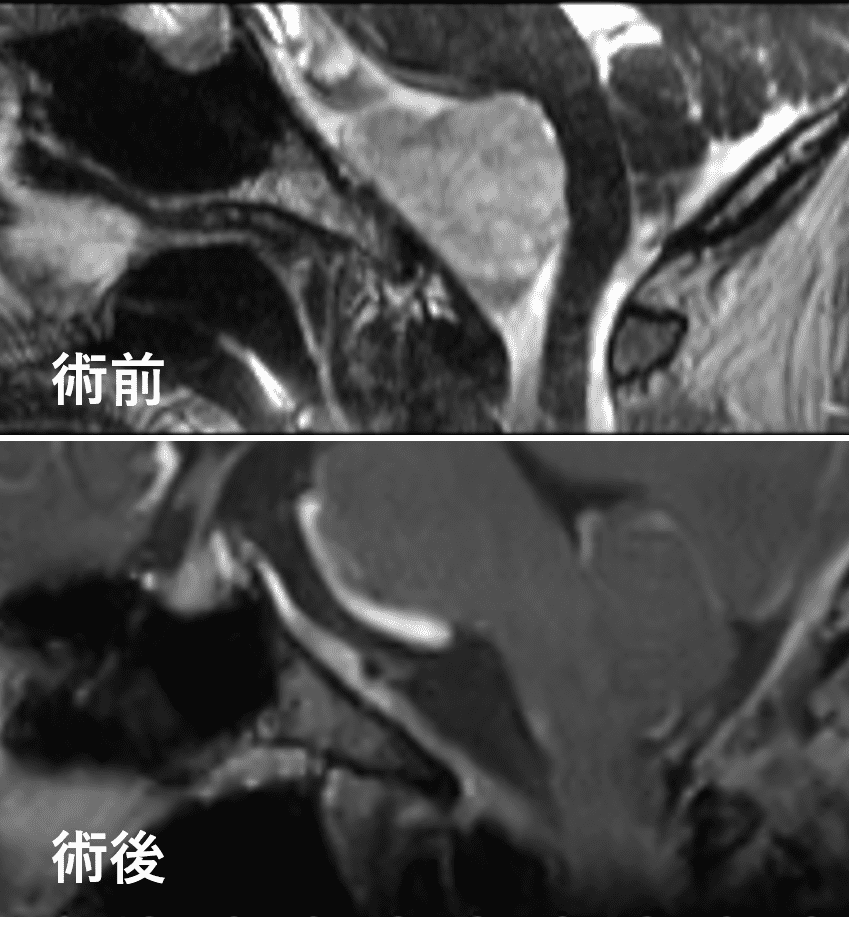 頭蓋咽頭腫瘍の術前術後