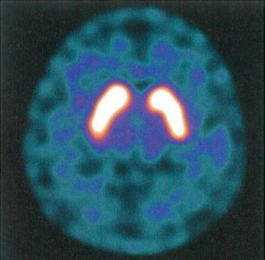 老年健常者のDAT-Scan画像