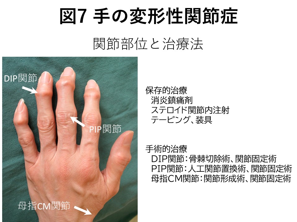 手の変形性関節症