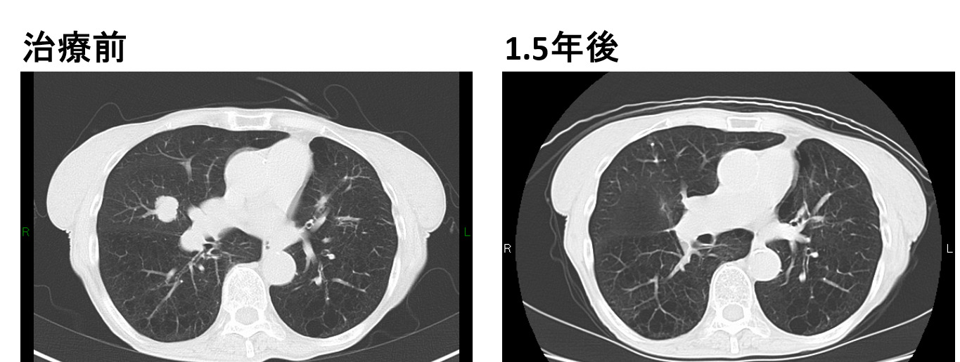 肺がんの定位放射線治療