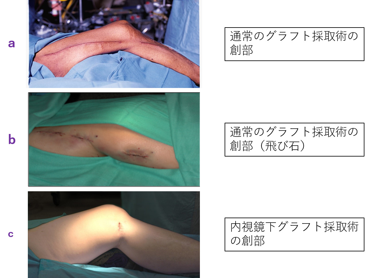 内視鏡下静脈グラフト採取の手術創