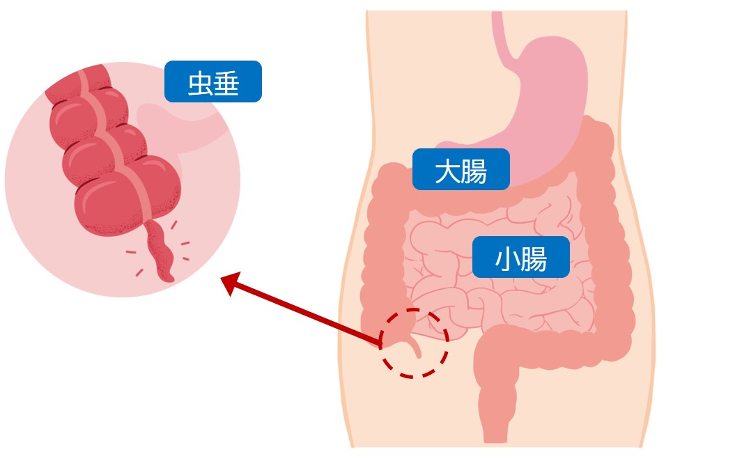 急性虫垂炎の図