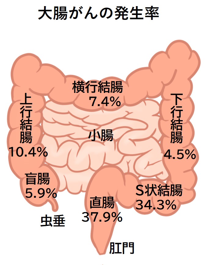 大腸がんの発生率