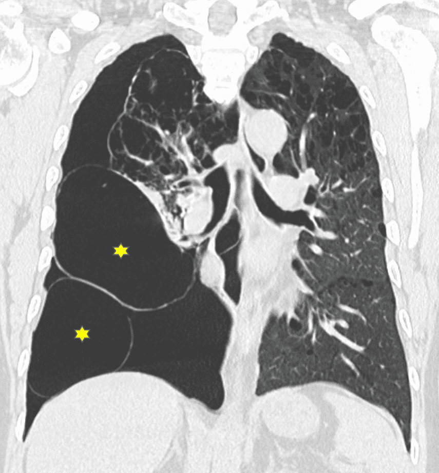 巨大肺嚢胞のCT画像