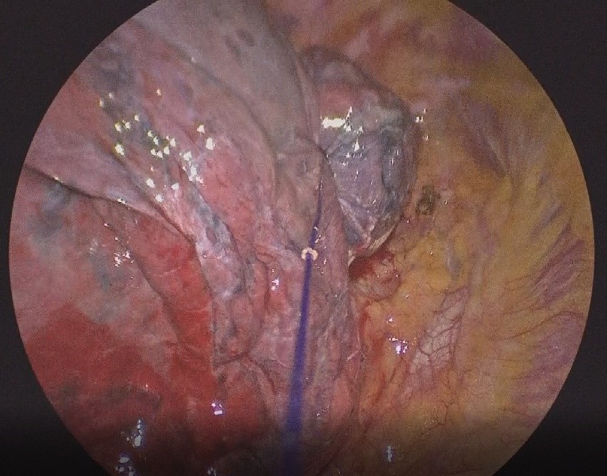巨大な肺嚢胞の単孔式胸腔鏡手術