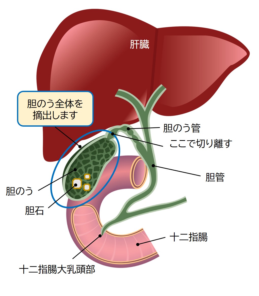 胆のう結石の治療