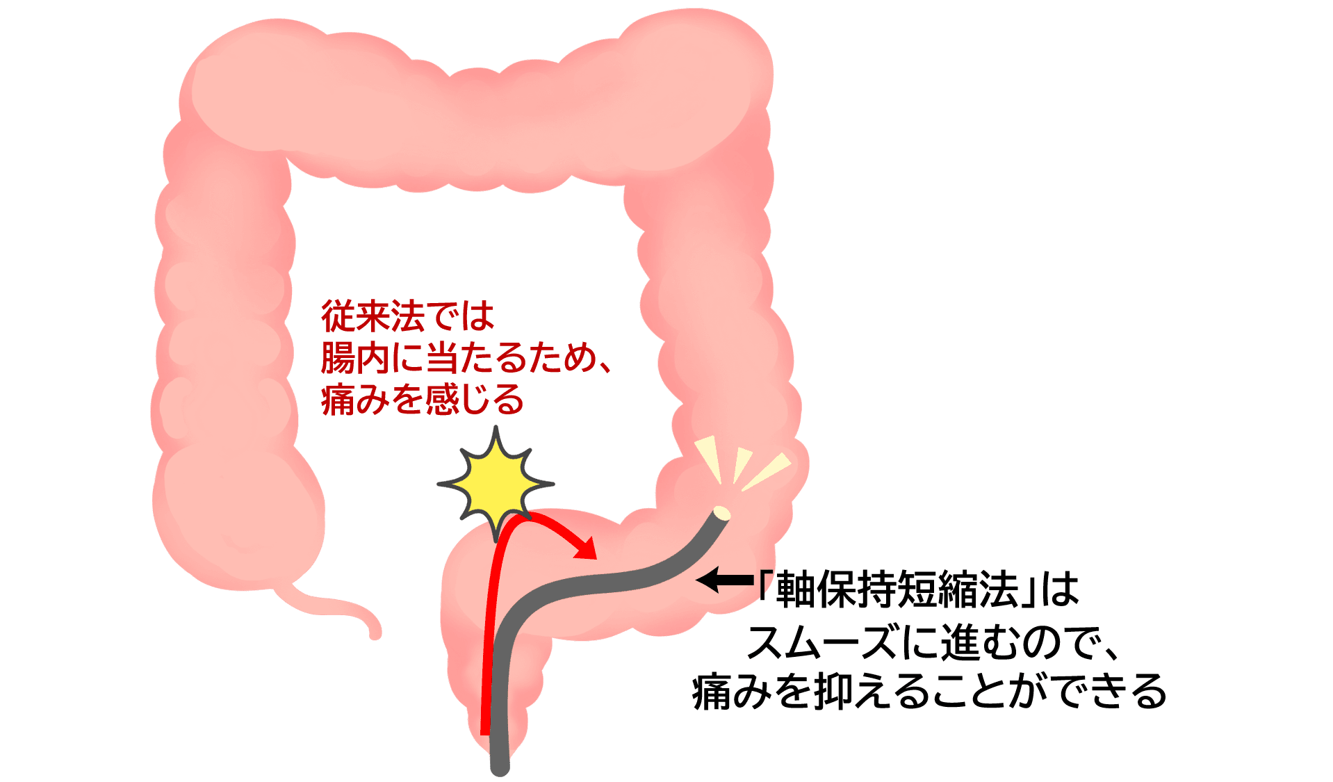 大腸内視鏡検査の軸保持短縮法
