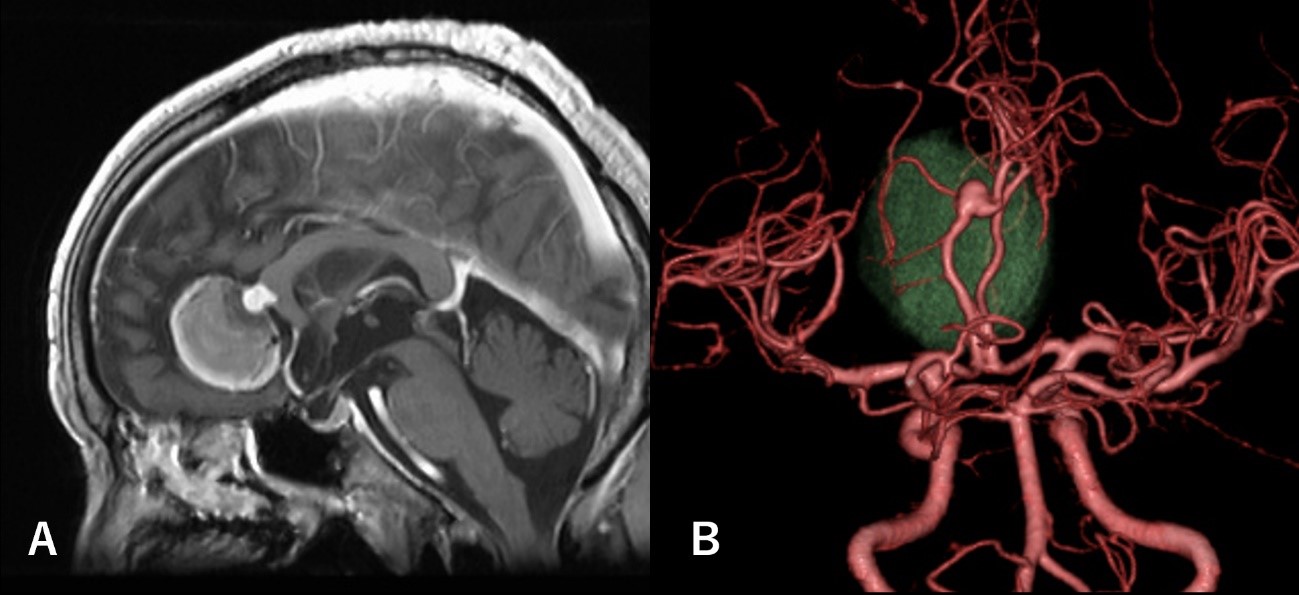 難治性動脈瘤に対するバイパス術の症例画像